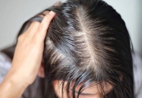 tóc mỏng là gì