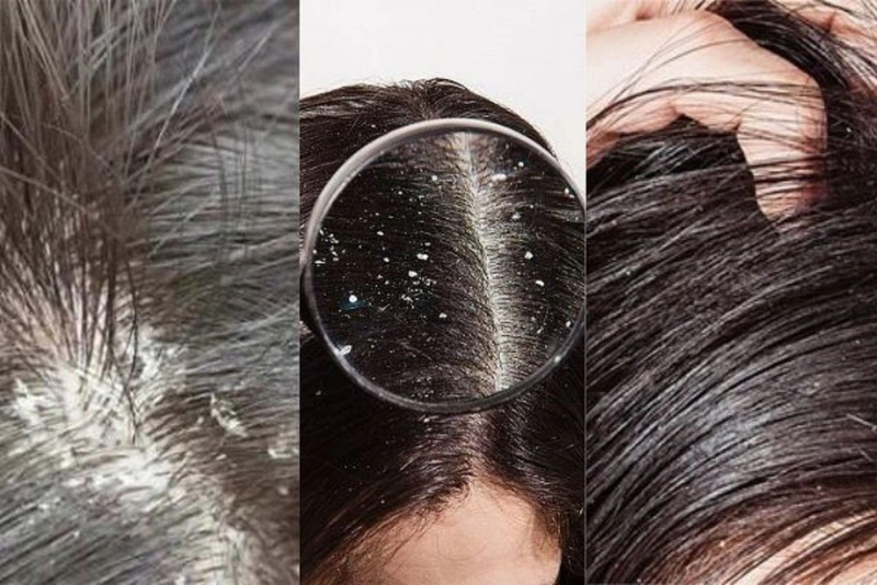 Điều Trị Bệnh Lý Da Đầu Hiệu Quả – Tóc Khỏe Mượt Tại A Voòng